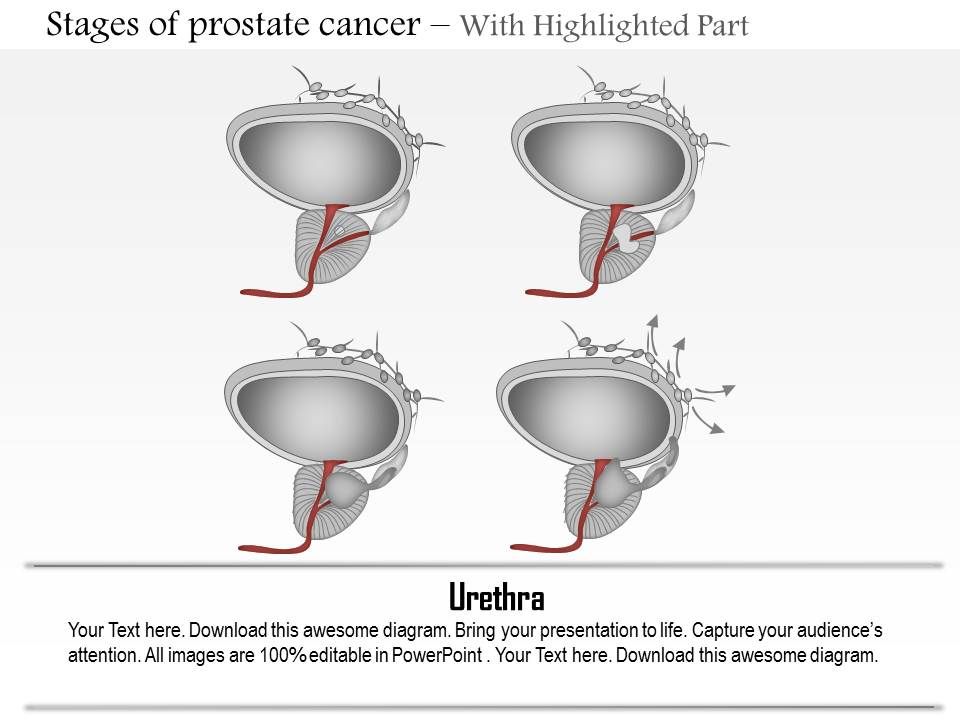 prostate cancer types ppt Mennyi ideig tart a krónikus prosztatitis